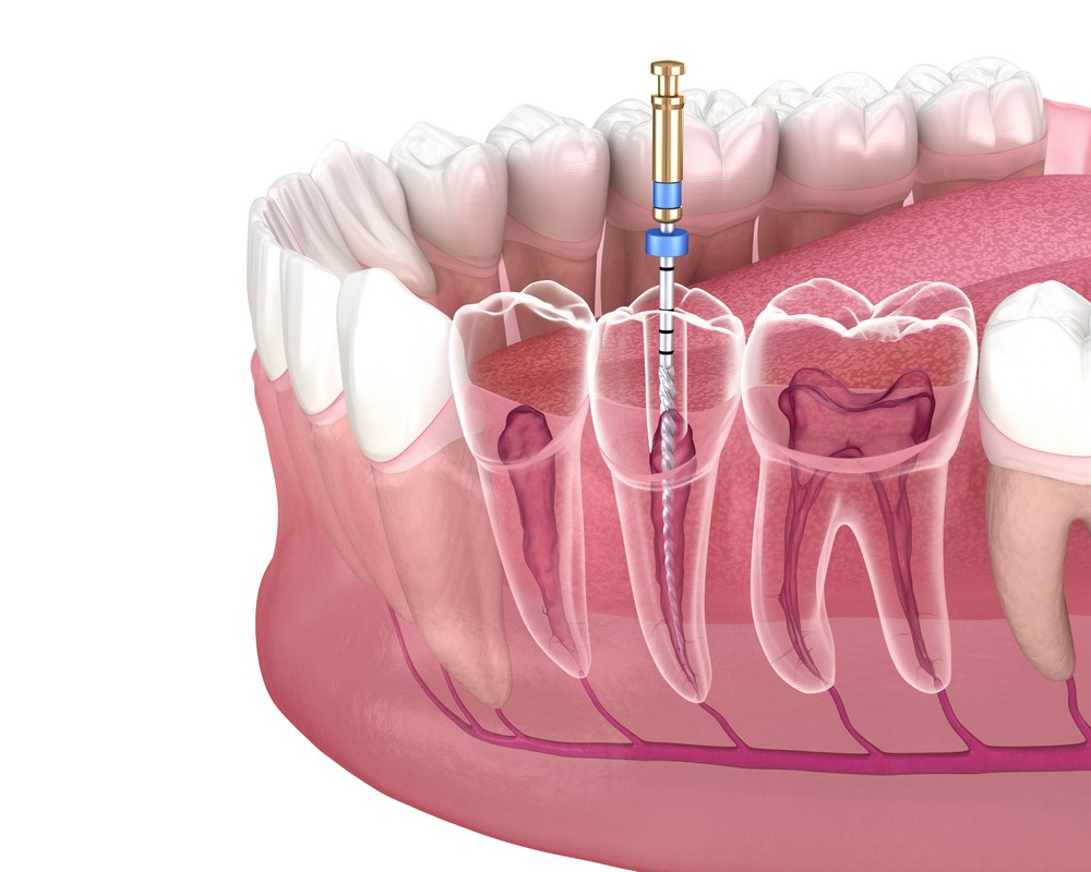 tratament endodontic baia mare, endodontie baia mare, tratament canal baia mare