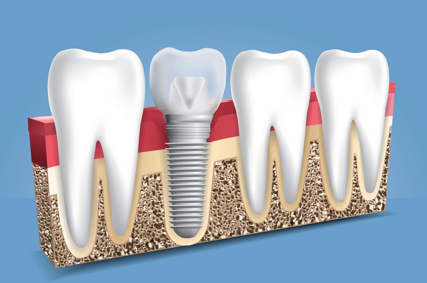 implant dentar baia mare, implantologie baia mare, clinica stomatologica identify baia mare