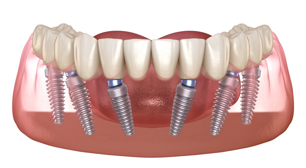 implant dentar fast and fixed baia mare, implantologie baia mare