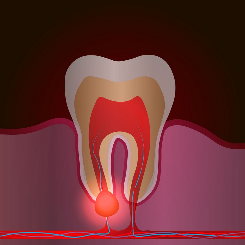 abces dentar, stomatologie baia mare