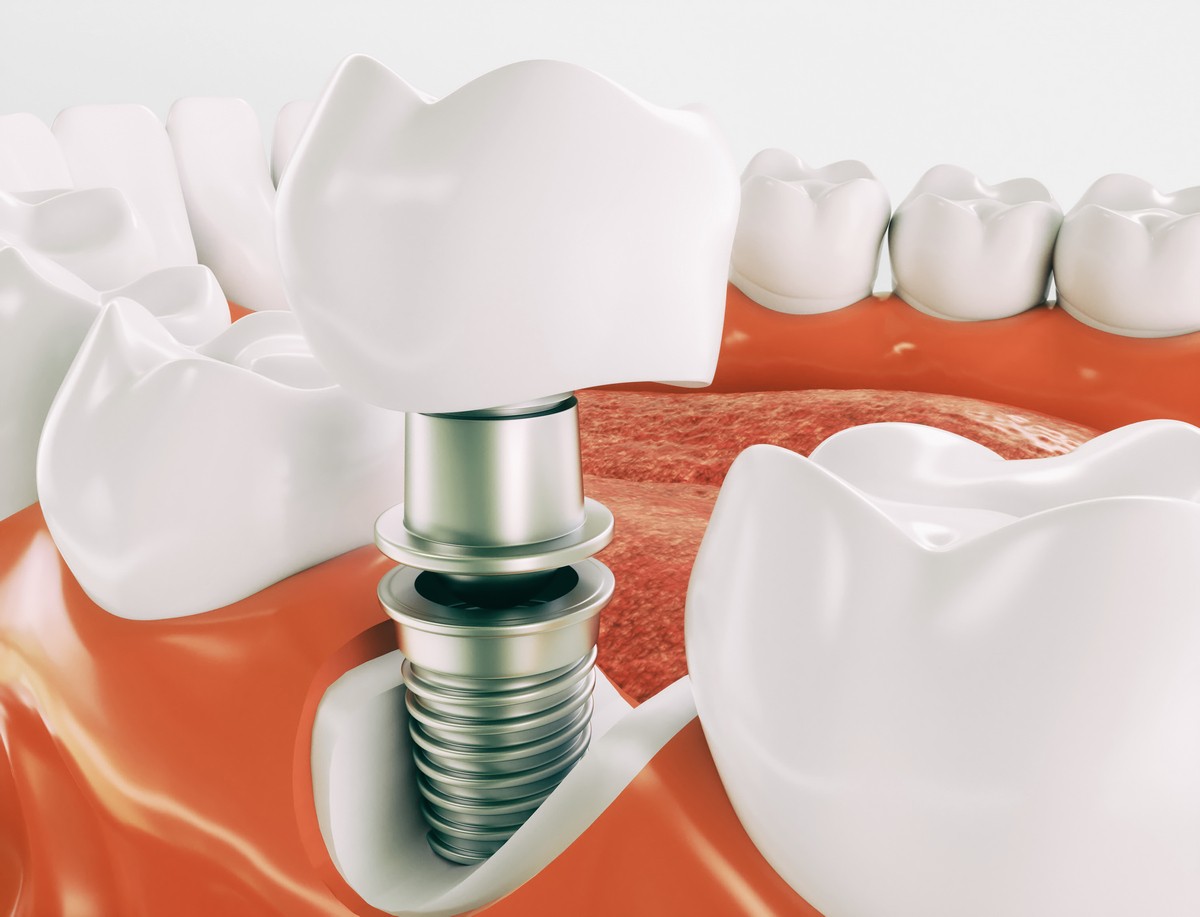 implant dentar baia mare, clinica stomatologica baia mare identify