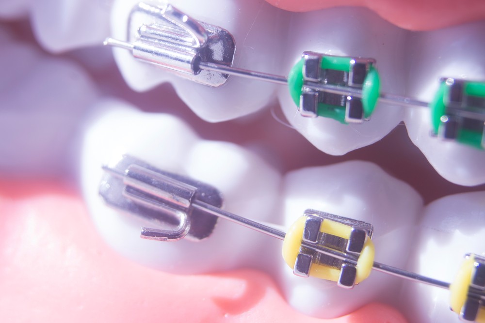 aparat dentar baia mare, ortodontie baia mare, clinica stomatologica identify baia mare