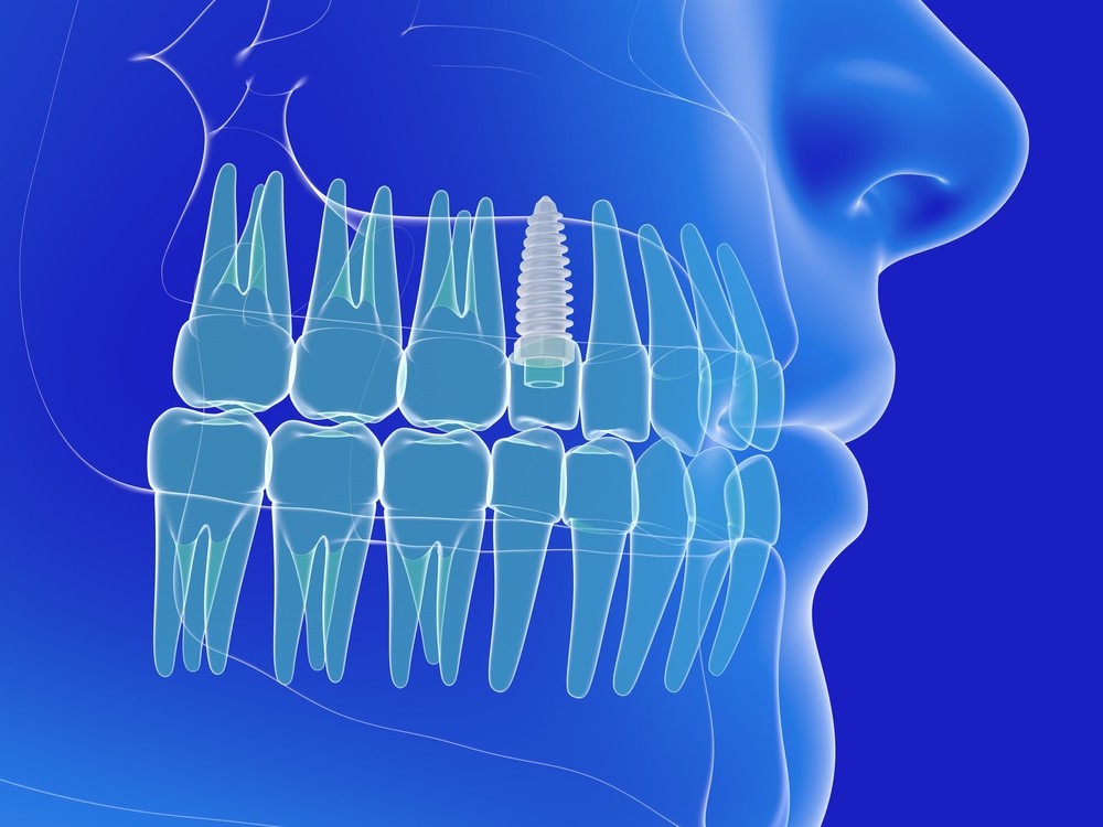 implant dentar baia mare, clinica stomatologica identify baia mare