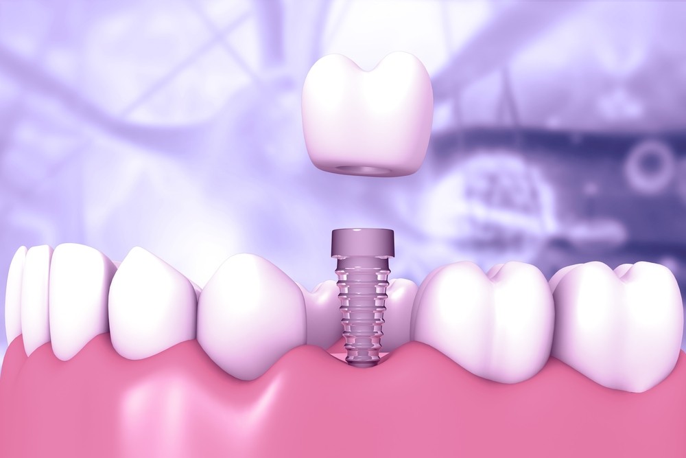 implant dentar baia mare