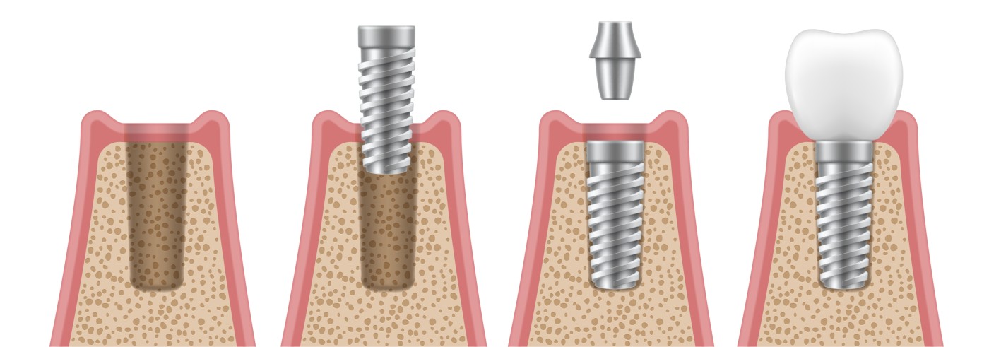 implant dentar baia mare, implantologie baia mare, clinica stomatologica identify baia mare