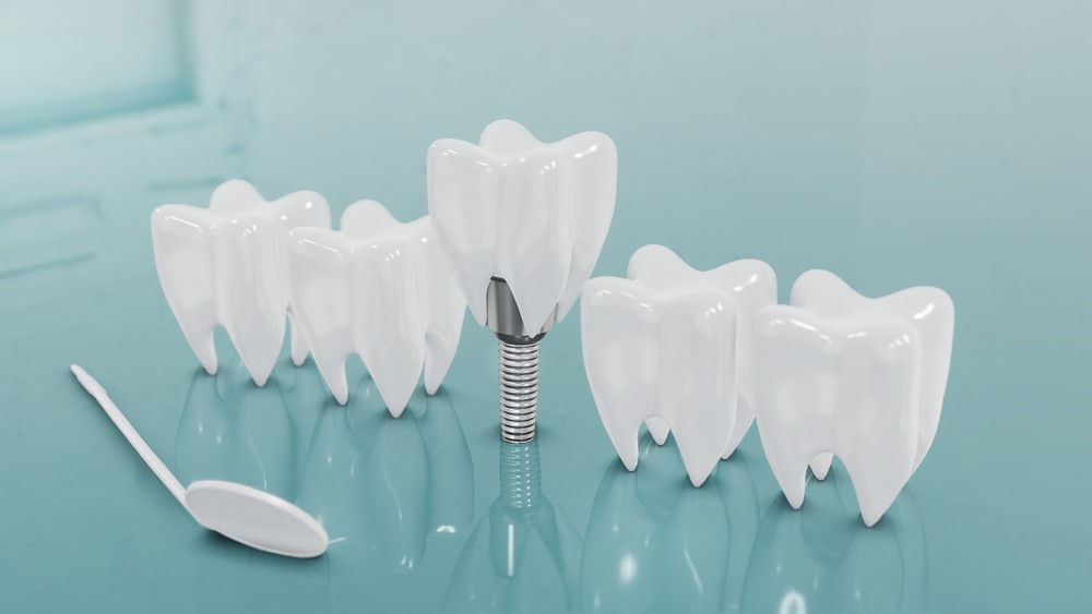 implant dentar baia mare, clinica stomatologica baia mare, clinica stomatologica identify
